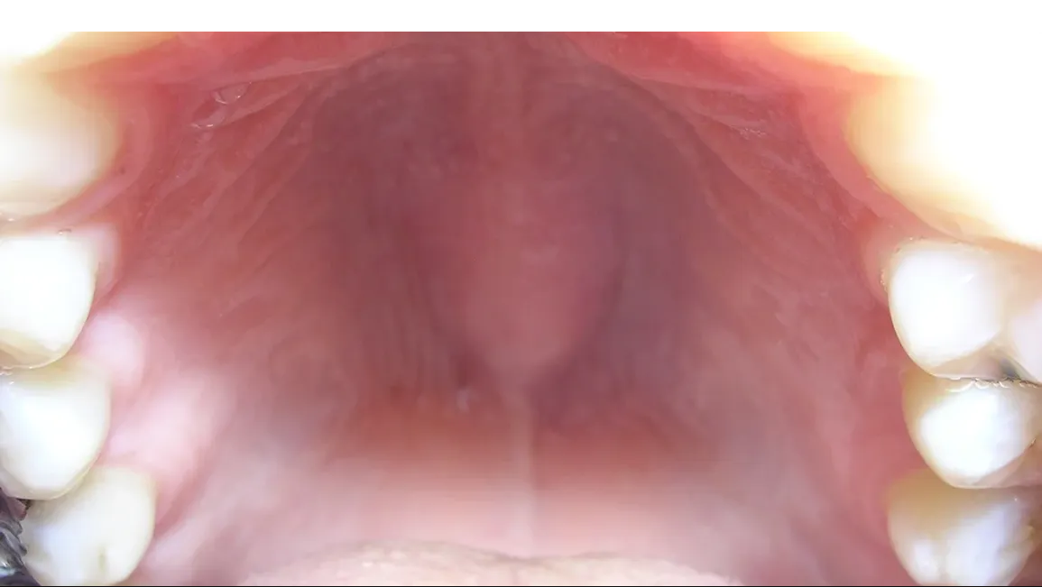 Lump in Roof of Mouth Hurts: Causes, Symptoms, and Effective Treatment Options